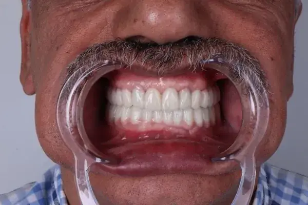 Dental Implants — All-on-4 & All-on-6 — close-up 2