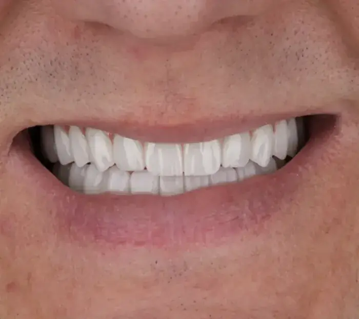 Smile transformation 9 — after
