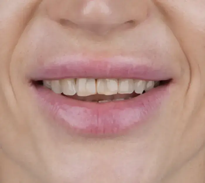 Smile transformation 12 — before