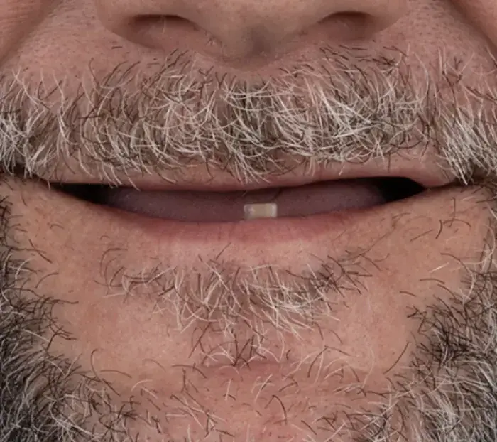 Smile transformation 7 — before
