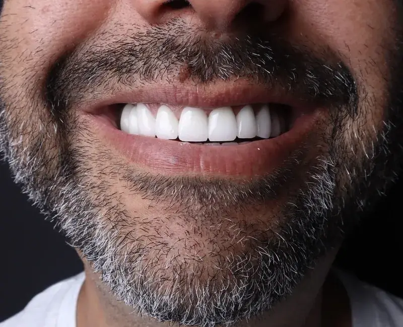 Zirconia Crowns — close-up 1