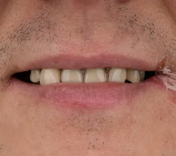 Smile transformation 9 — before