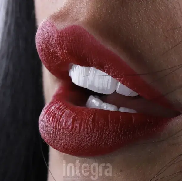 Veneers — close-up 2