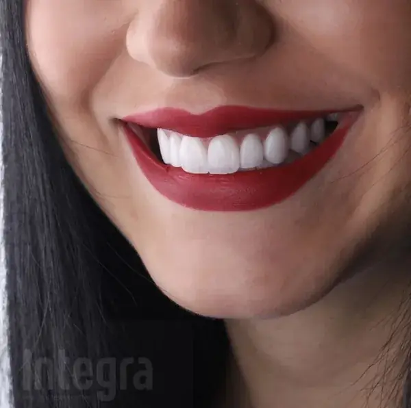 Veneers — close-up 1