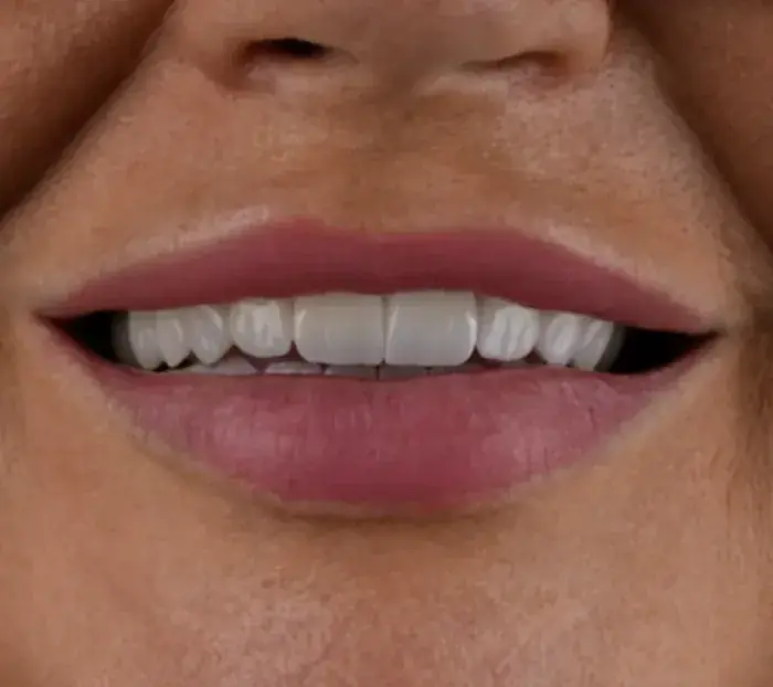 Smile transformation 10 — after