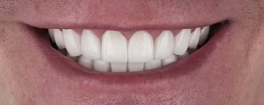 Smile transformation 2 — after