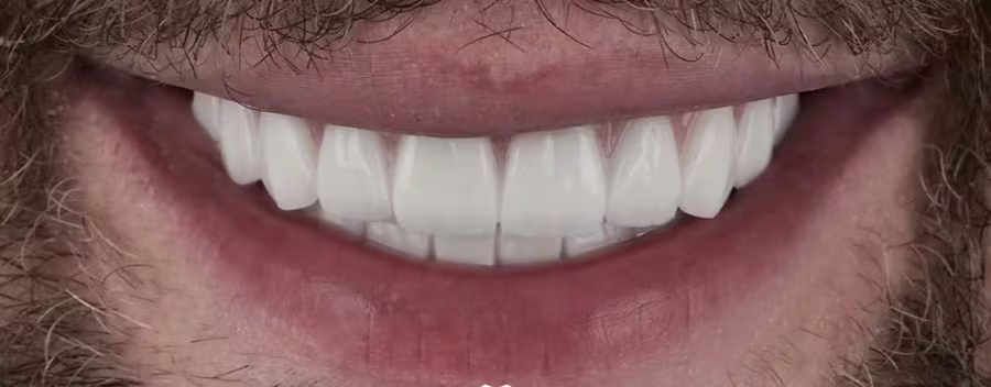 Smile transformation 5 — after