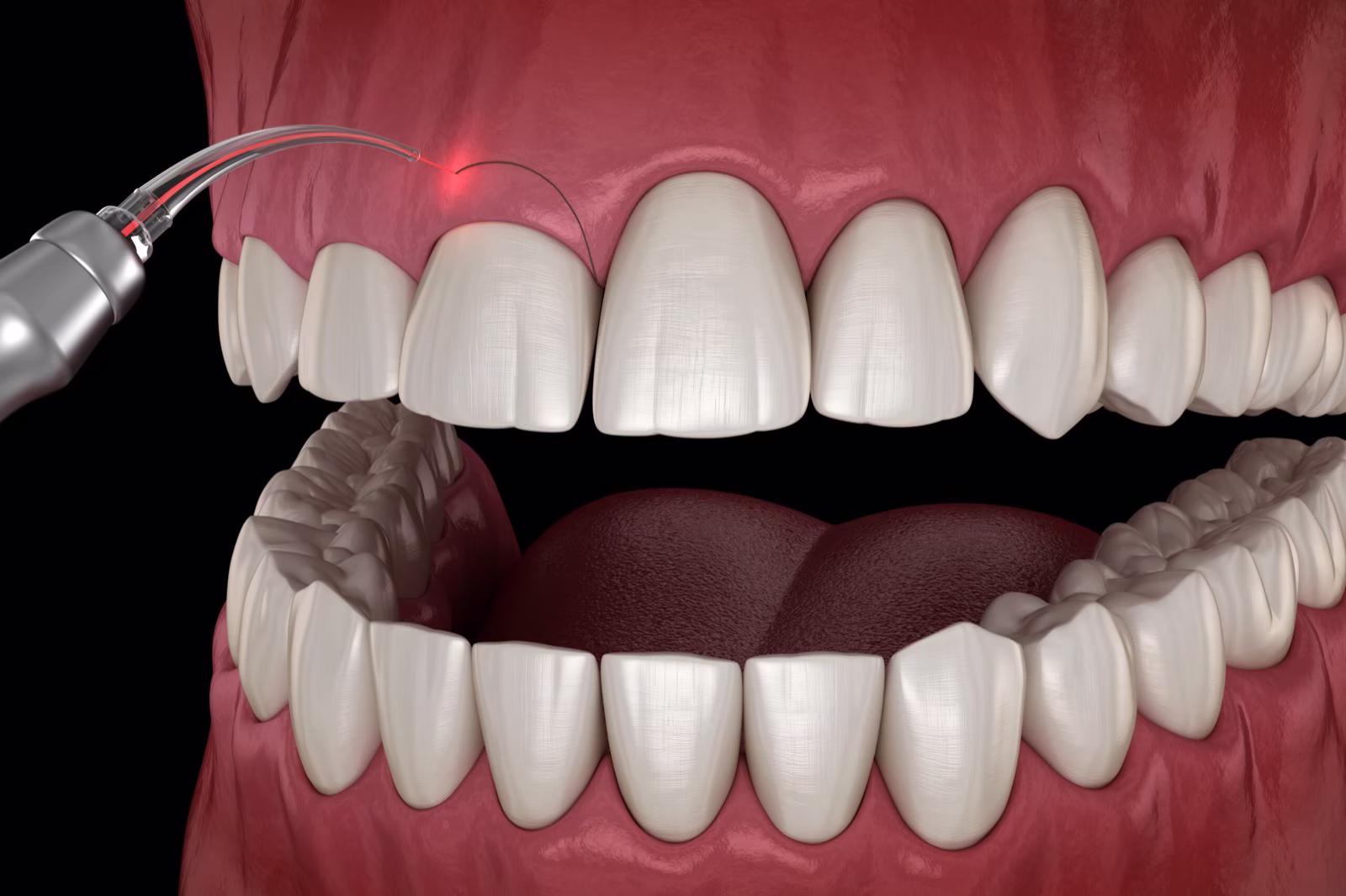 Laser gingivectomy reshaping the gumline
