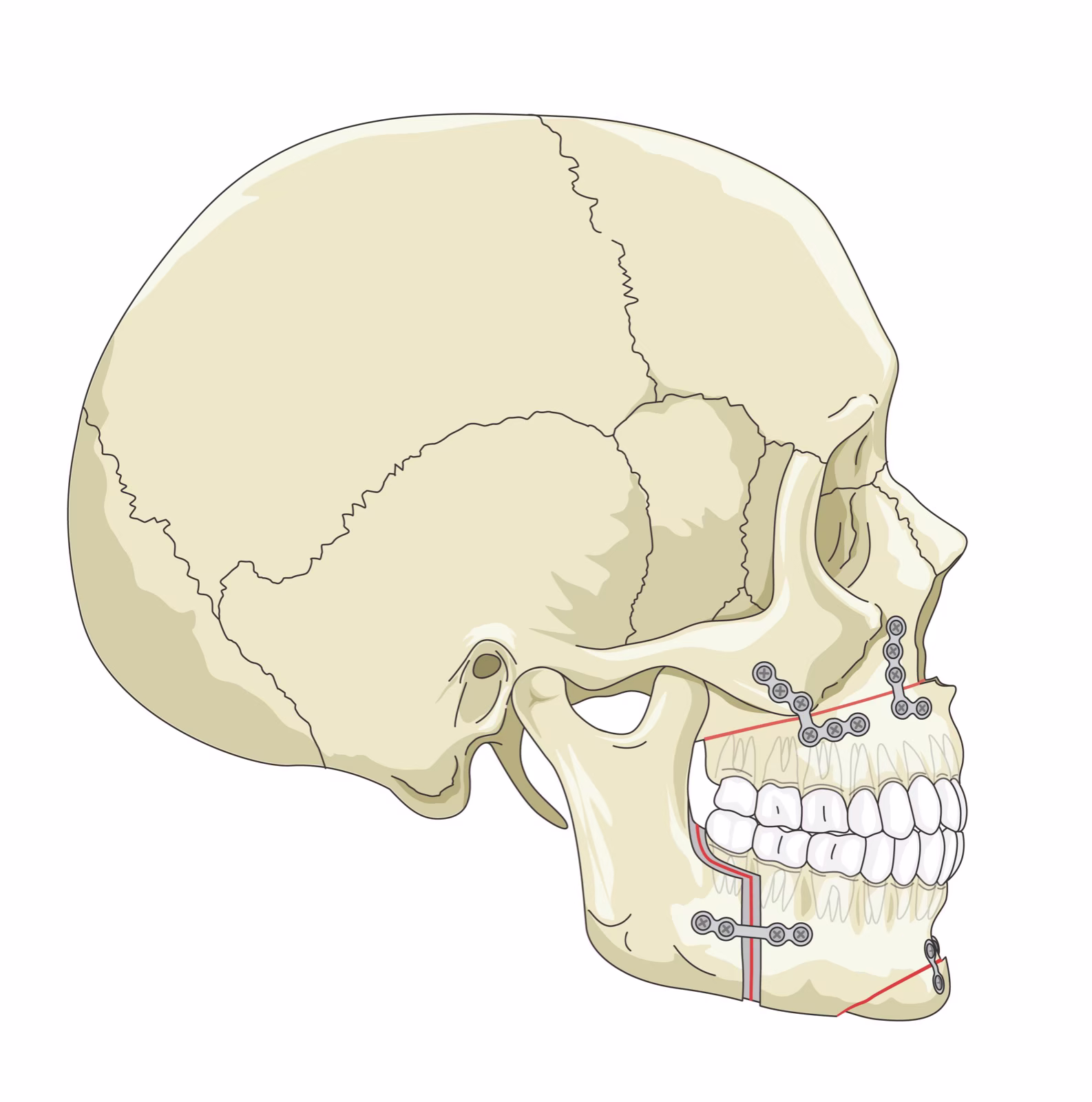 Skull illustration showing jaw surgery fixation hardware