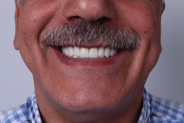 Dental Implants — All-on-4 & All-on-6 — close-up 1